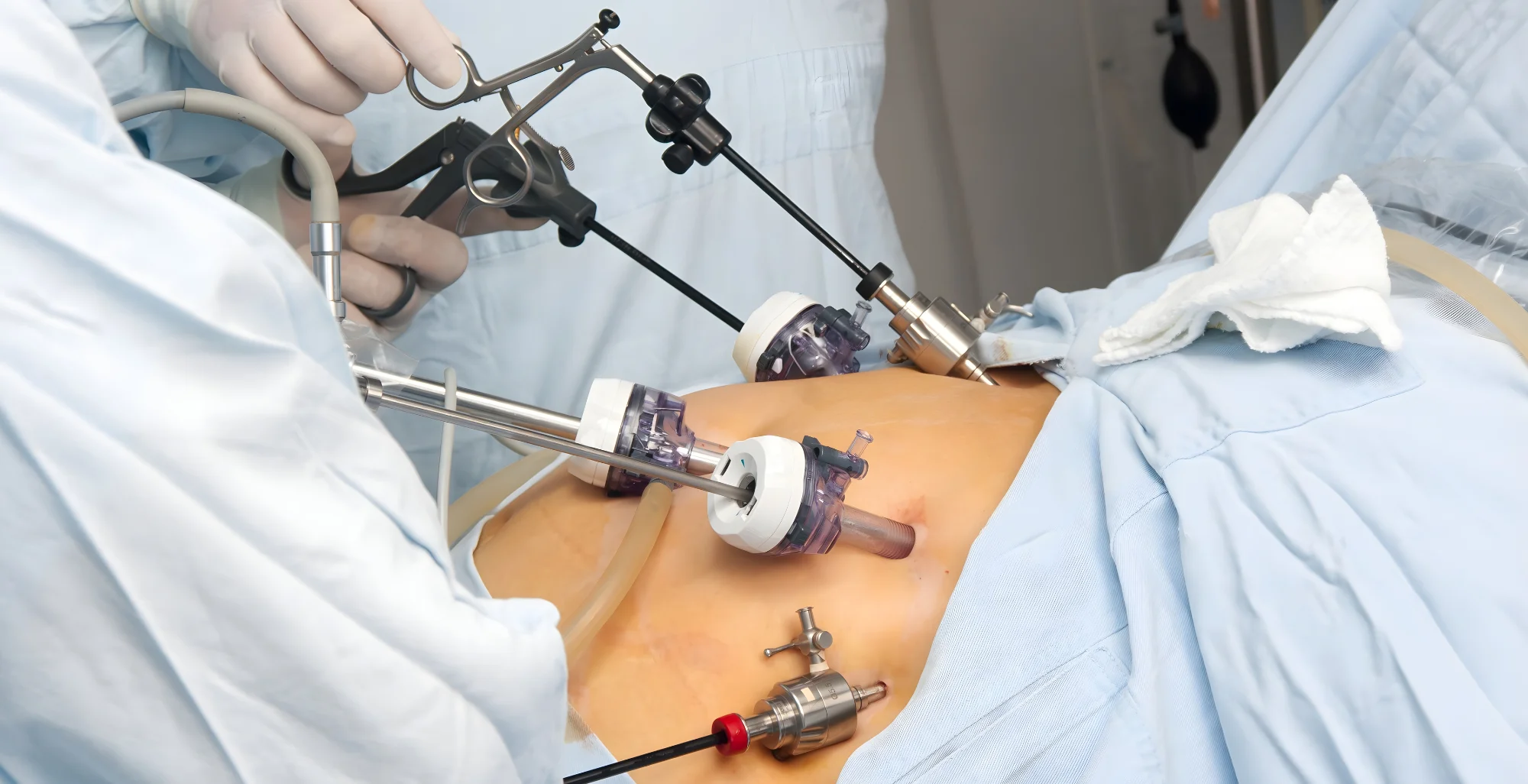 Laparoscopic Surgery in Nallagandla, Hyderabad